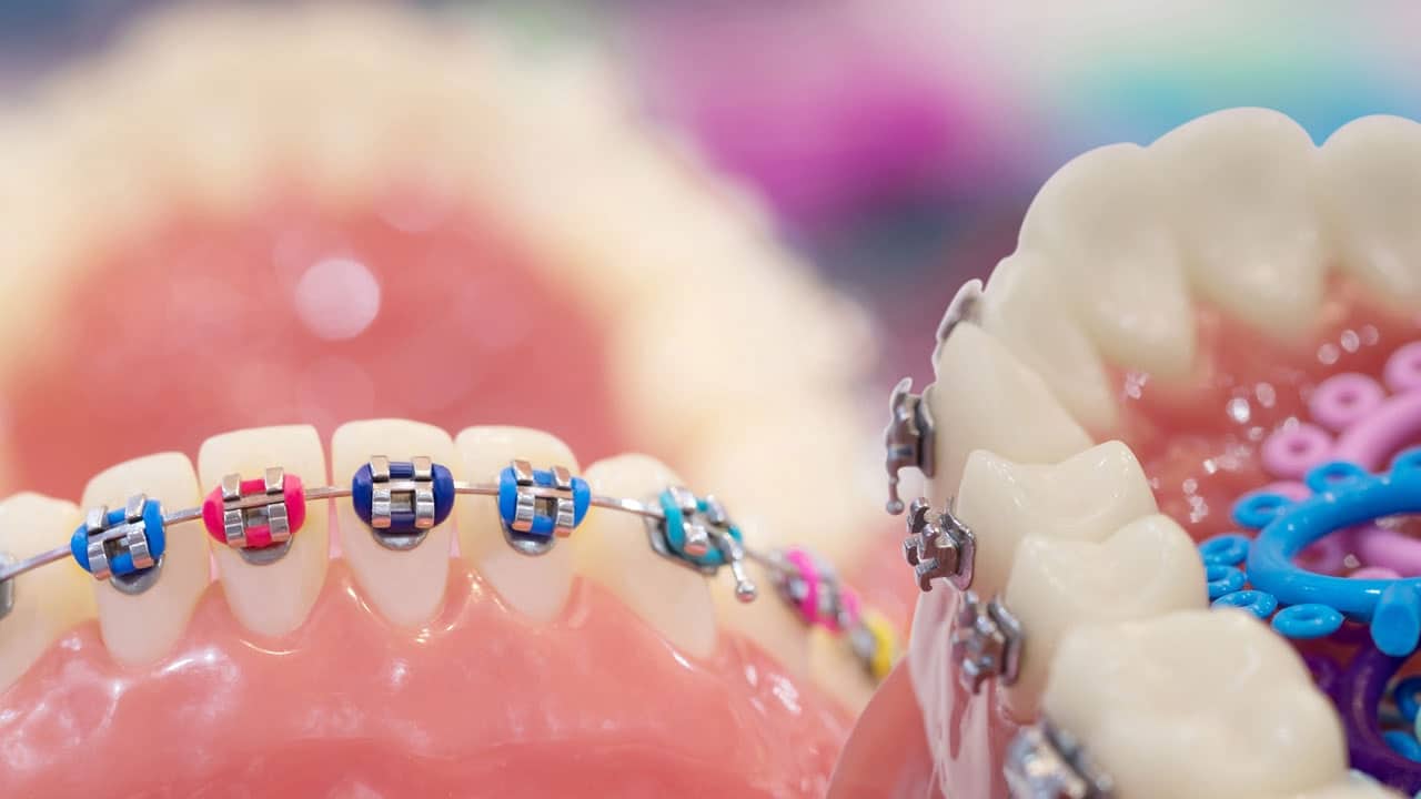 6 Surprising Facts About Braces That You May Not Know Anew Dental And Orthodontics 